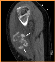 miositis3