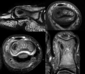 osteoma osteoide3