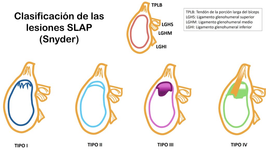 Clasificación de las lesiones SLAP de Snyder