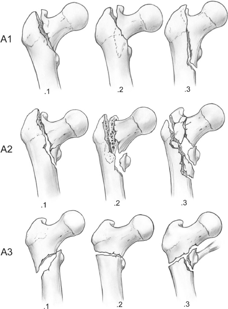 Fracturas de fémur proximal – Médicos Radiólogos