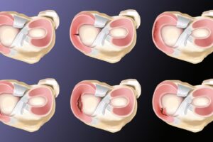 Lesiones meniscales | Repaso anatómico y clasificación de las lesiones